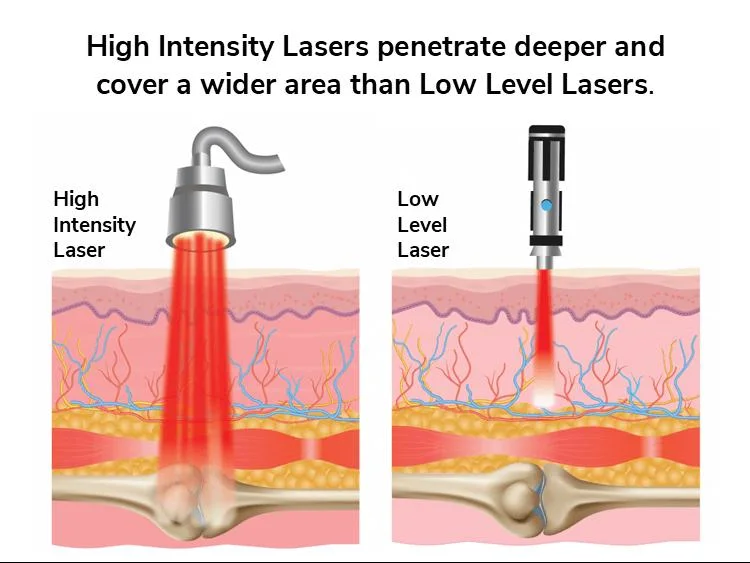 60 Watts Medical Cold Class 4 Laser Therapy 1064nm 980nm Laser Pain Relief Anti-Pain Physiotherapy Equipment Laser Physiotherapy Device