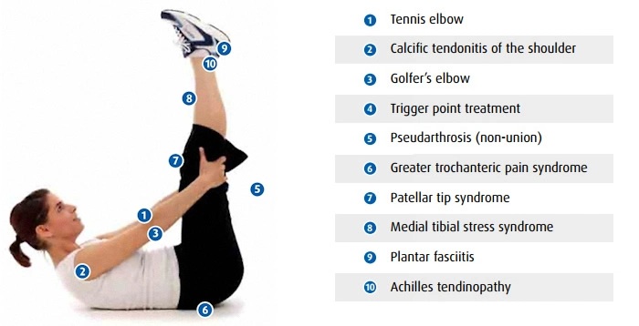 Physiotherapy Machine Shockwave Therapy for Heel Spur