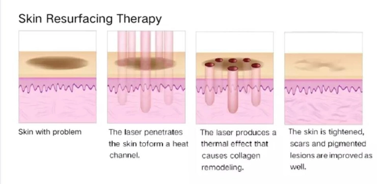 CO2 Fractional Laser Vaginal Tightening Skin Resurfacing/Acne Scar Removal Machine