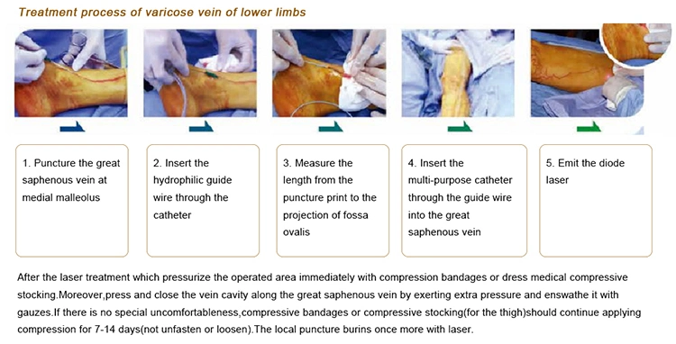 Leg Veins Ablation Left Veins Evlt Laser Machine Varicose Veins Pain Relief 1470nm Diode Laser Machine