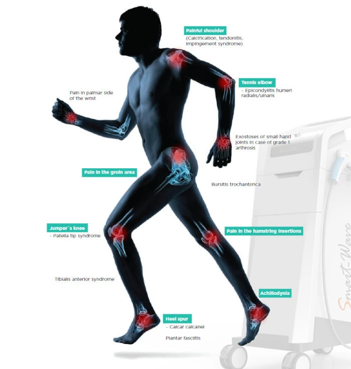 BS-Swt6000 Wound Healing Shock Wave Machine for Diabetic Foot