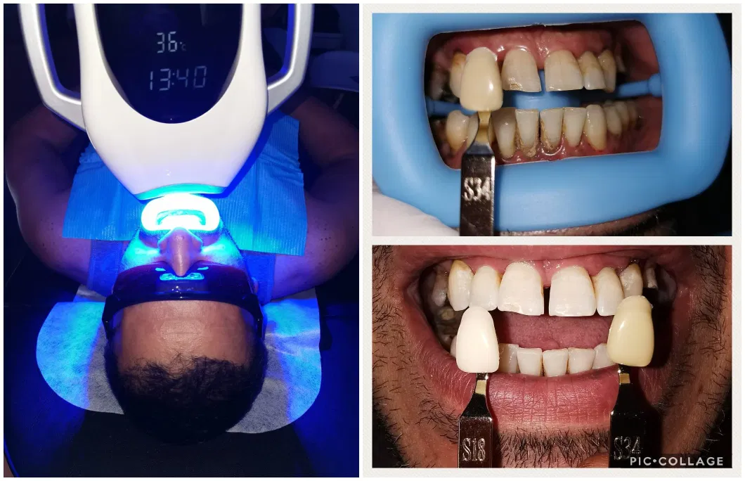 CE Approved SPA Portable Whitening Teeth Machine Light 60W Mobile Laser LED Teeth Whitening Machine for Professional Us