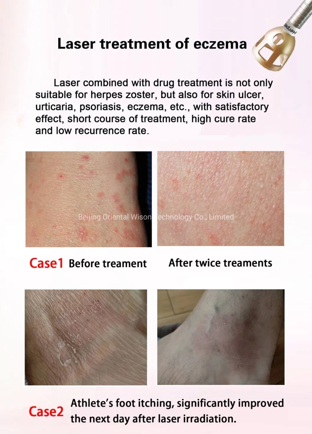 980nm Diode Laser Fiber Vascular Removal with Cold Hammer Pain Relief Surgical Laser Lipolysis Slimming Device