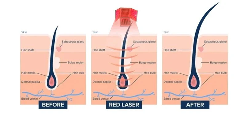 Portable 650nm Cold Hair Loss Treatment Device Lllt Diode Laser Hair Scalp Regrowth Growth Machine