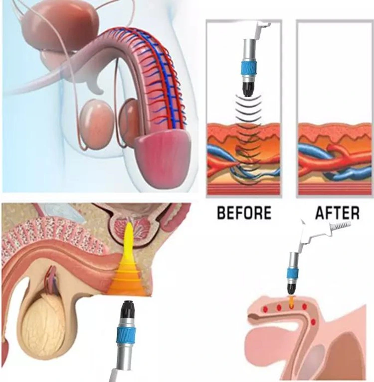 Newest Therapy ED Dysfunction Pain Relief Mens Electric Shock Wave Physiotherapy Equipment