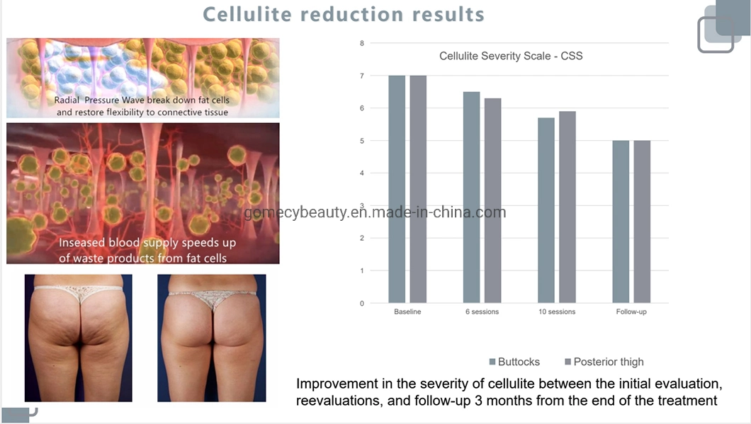 Vacuum Shockwave Physical Therapy Equipment ED Treatment 2 in 1 ED Treatment Cellulite Reduction Machine