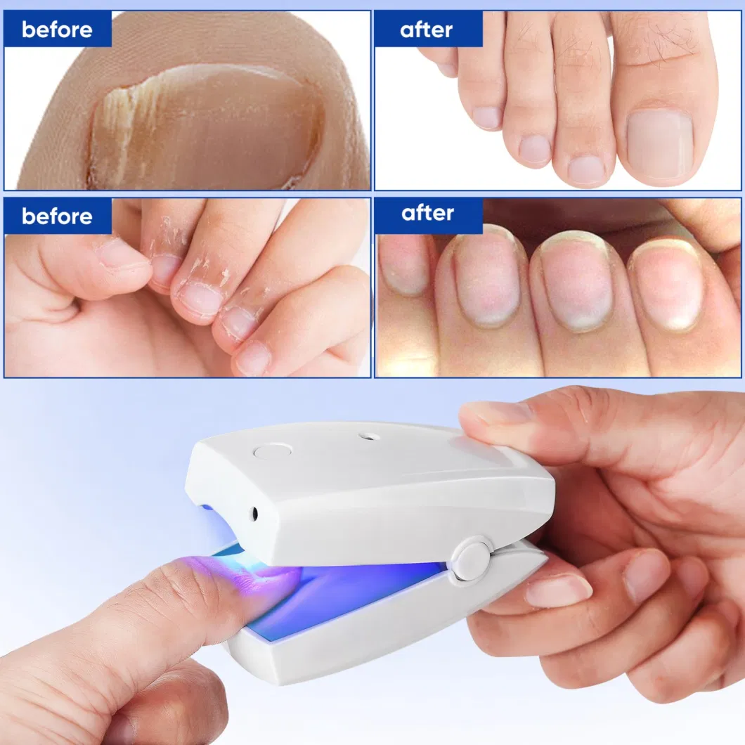 Source Supplier Portable 905nm Low Level Laser Nail Fungus Laser Treatment Device