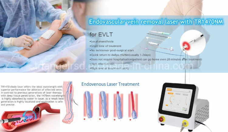 Leg Veins Ablation Left Veins Evlt Laser Machine Varicose Veins Pain Relief 1470nm Diode Laser Machine