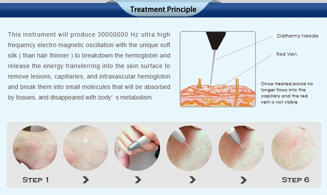 30MHz Rbs High Frequency Portable Diode Vascular Removal Vein Wave Machine