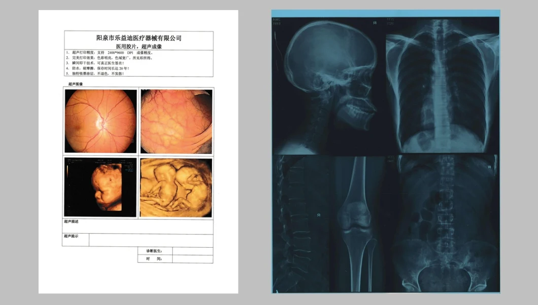 Hospital Ultrasound White Digital Sunlight Dry Films