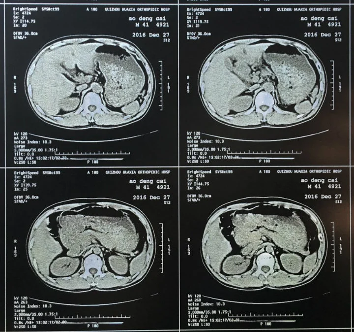 Hospital Ultrasound White Digital Sunlight Dry Films