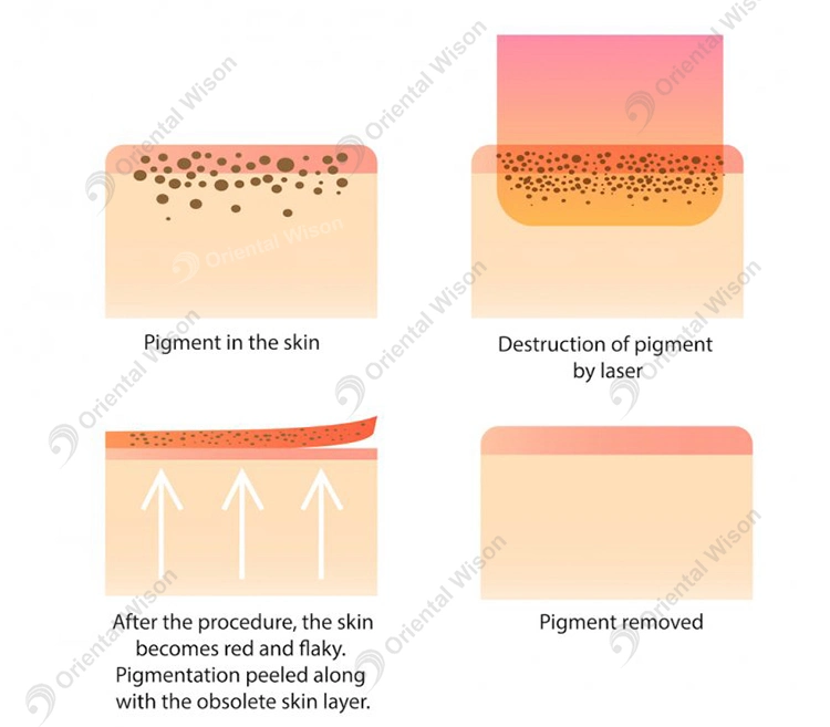 Dali Beauty Picosecond Picolaser Tattoo Removal Q Switched ND YAG Laser Spot Pigment Alex Laser Tattoo Remove Carbon Peeling Black Doll Skin Whitening