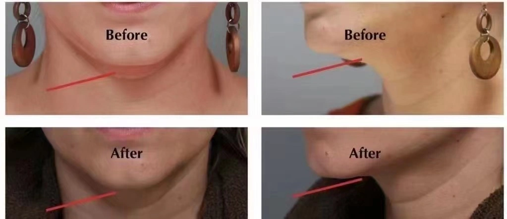 High Quality Belkyra Injectable Kybella Injectable Is a Safe Injectable Substance to Reduce and Possibly Eliminate Excess Fat Under The Chin Double Chinus$ 50-