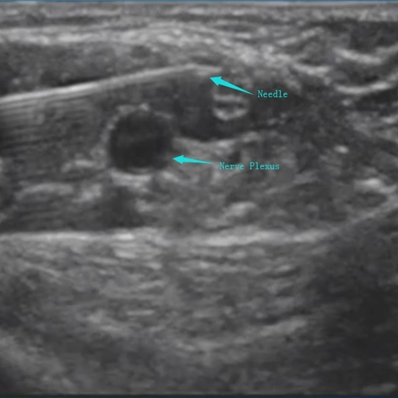 Echogenic Needle Nerve Block Plexus Needle