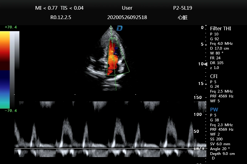 Ultrasound Scanner Color Dopper Portable Cardiac Ultrasound Dw-P60