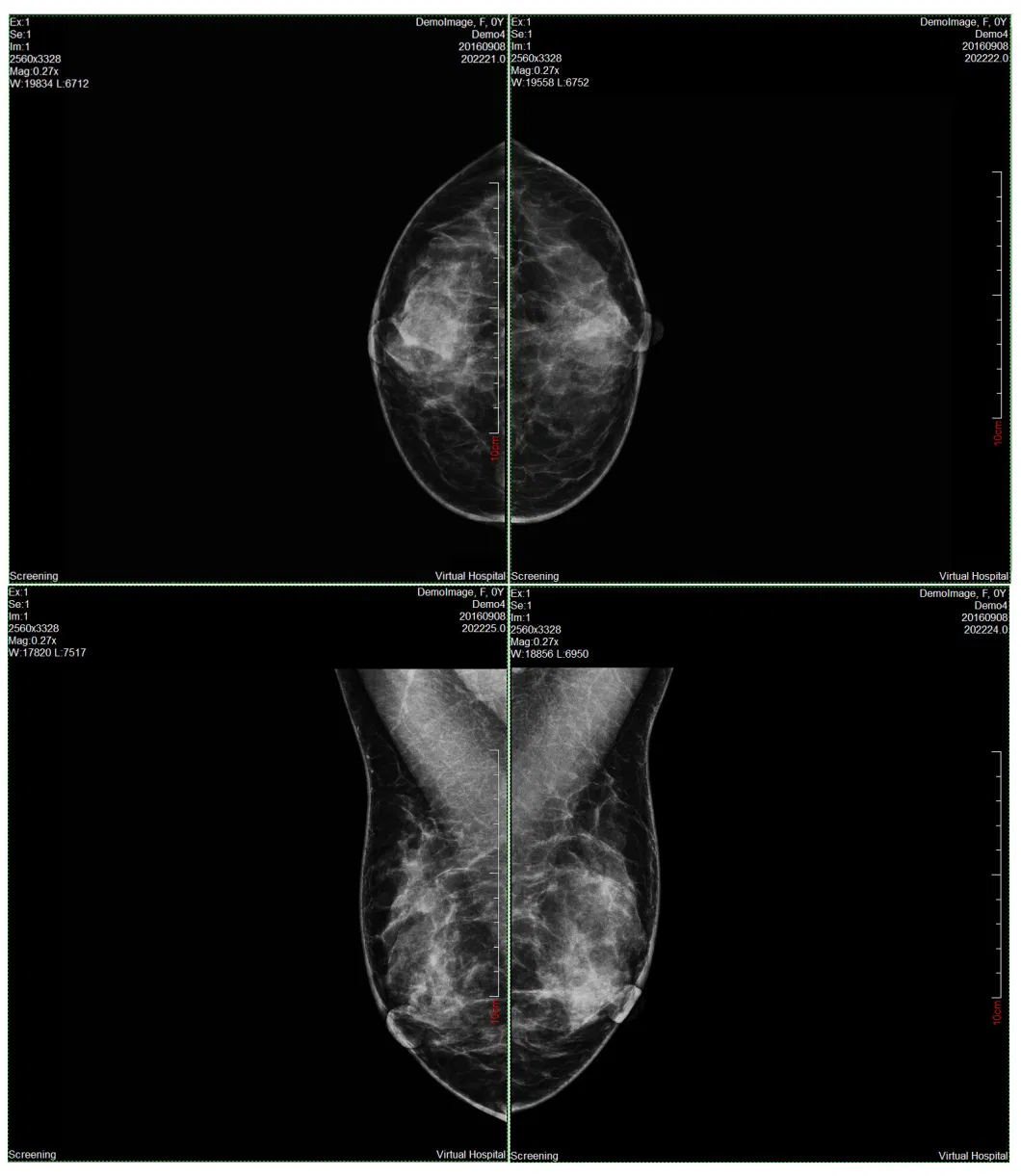 Medical Digital Mammography System Xray Machine for Women