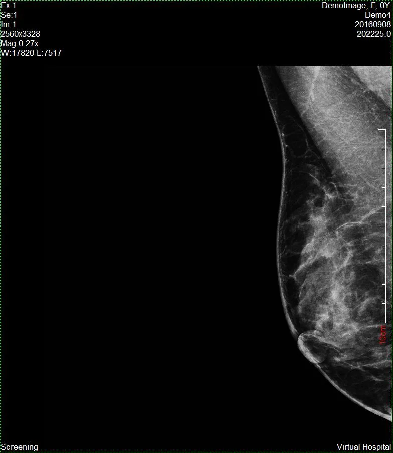 Medical Digital Mammography System Xray Machine for Women