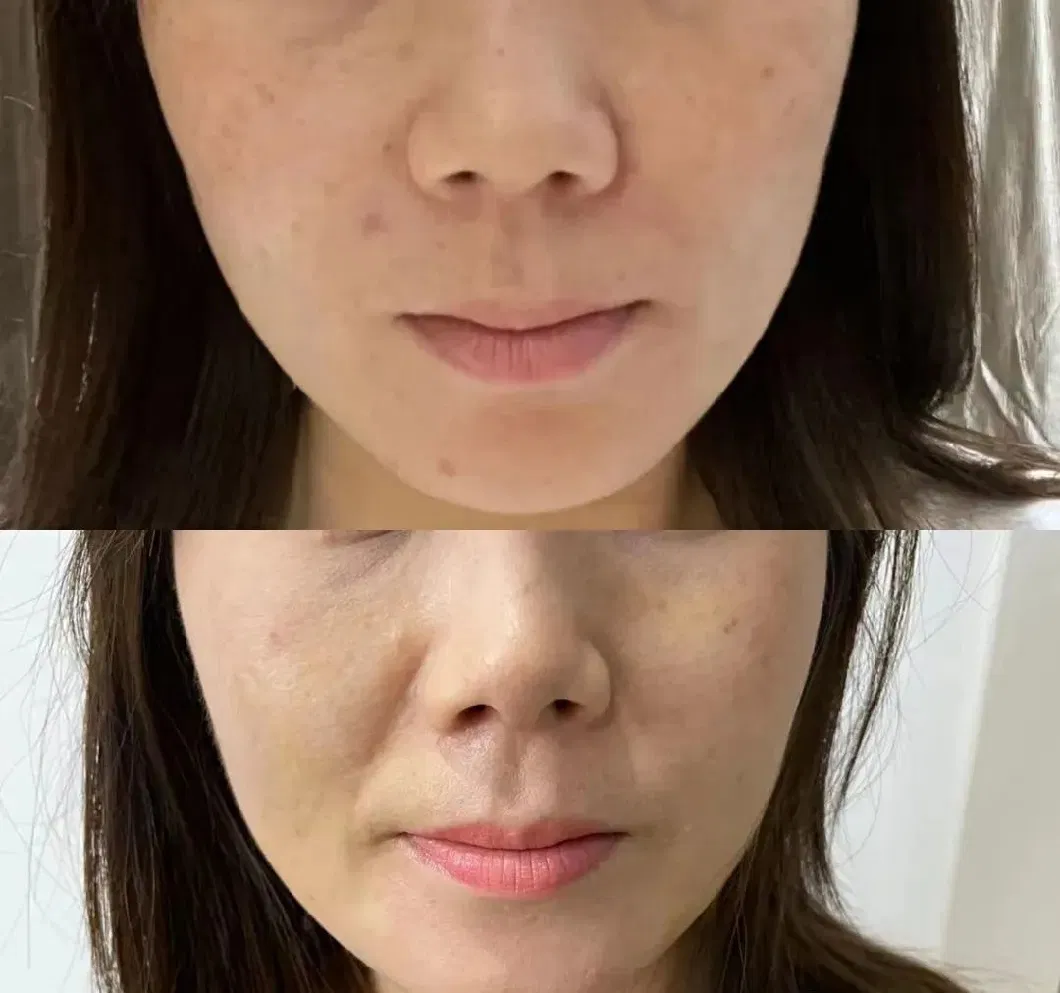 Facial Gain Injection Under Eye Circle Tighter Whitening to Remove Dark Circles