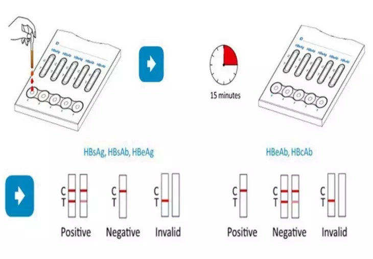 Hbsag HBsAb Hbeag Hbeab Hbcab 5 in 1 HBV Combo Test Kit