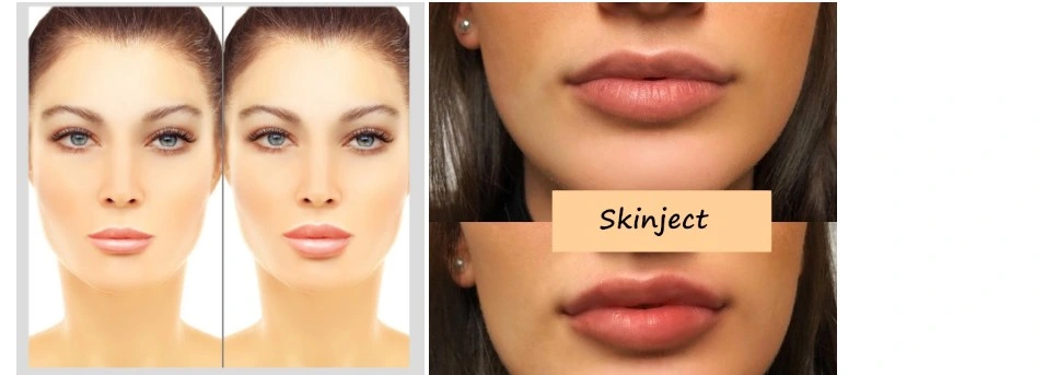 Skinject 2ml Derm Ha Injectable Hyaluronic Acid Dermal Fillers for Face