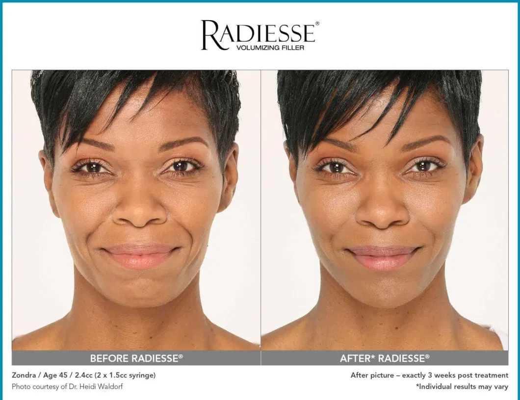 Radiesse Volassom Facetem Korean Filler Calcium Hydroxyapatite Filler for Wrinkle Removal