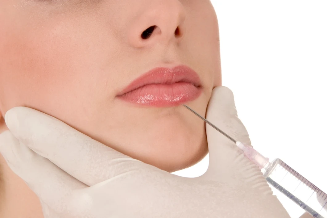 Hyaluronate Acid Dermal Filler for Lips and Anti Aging