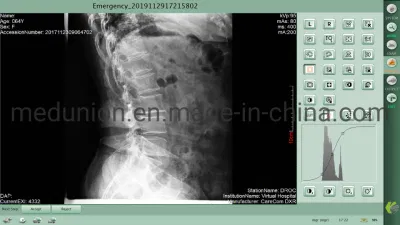 Лучшая цена 14&quot;x17&quot; беспроводной Csi рентгеновского цифровой плоский детектор Mslcv02