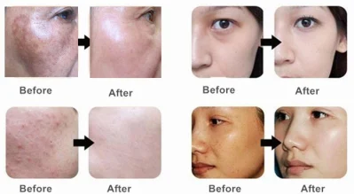 Whitening Brightening Lightening Skin Revitalizing Meso Serums No Needle Free Needless Mezoterapia Serum