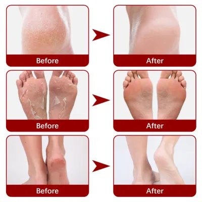 OEM Larger Size Exfoliating Callus Foot Peeling Pack Exfoliating Remover Care Feet Peel off Foot Masks