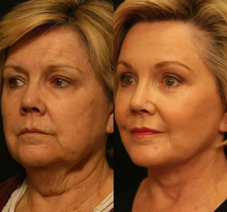 Skin Rejuvenation Cross-Linked Injectable Hyaluronic Acid for Face Shaping