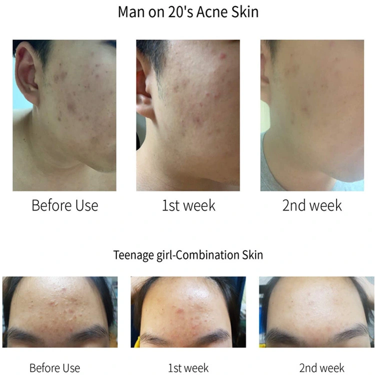 Hot Selling Salicylic Acid Acne Treatment Skin Brightening Serum