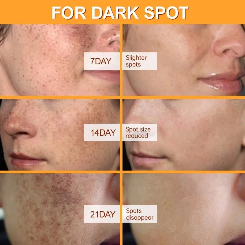 Dark Spots Corrector Face Bleaching Cream Whitening for Black Skin