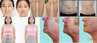 Dermeca suero lipolitico inyectable para disolución de grasas