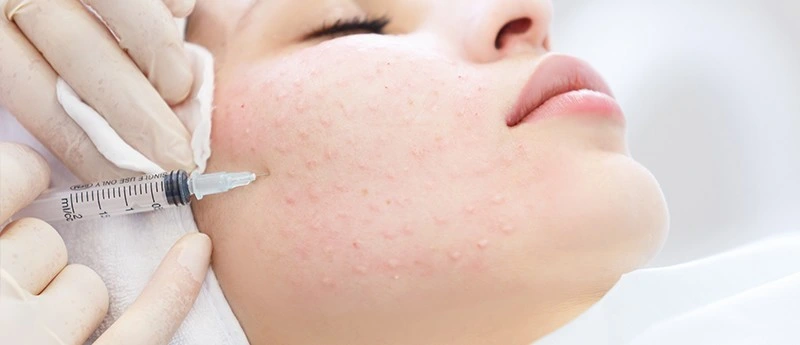 Hyaluronic Acid Facial Mesotherapy Meso Therapy Serum Brightening Skin Whitening