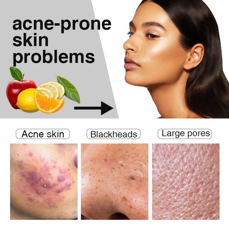 Ailke Wholesale Best Salycilic Acid Acne Pimple Face Brightening Acne Treatment Serum Facial