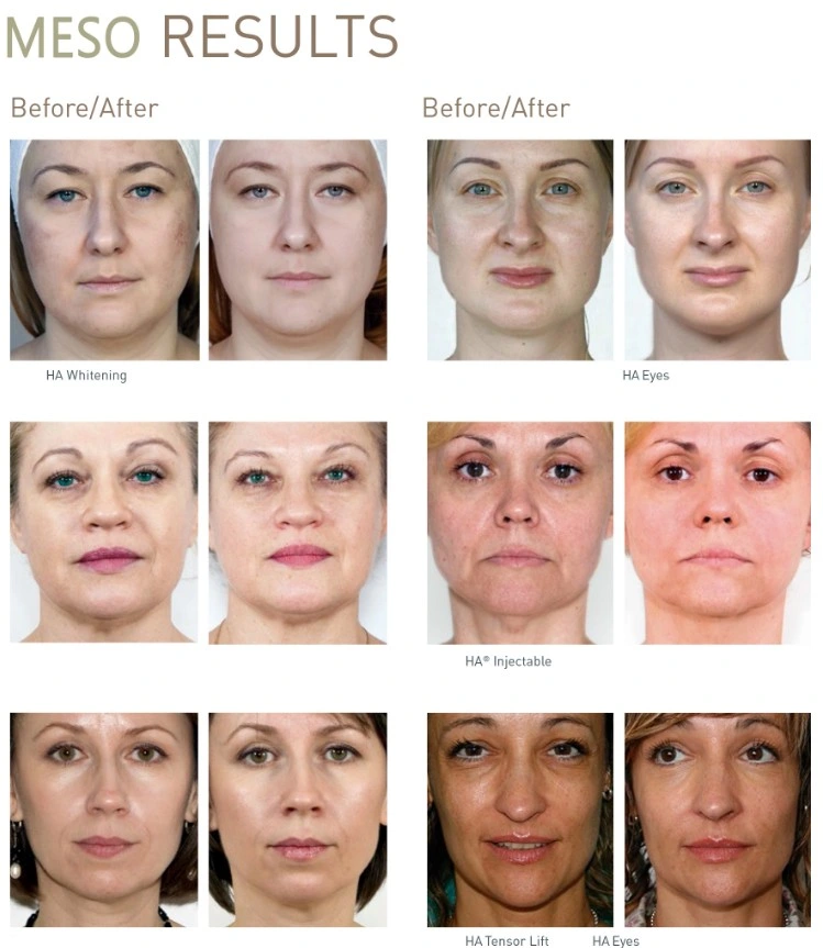 Skinject 18AA+ Anti-Aging Wrinkles Mesotherapy Serum Hyaluronic Acid