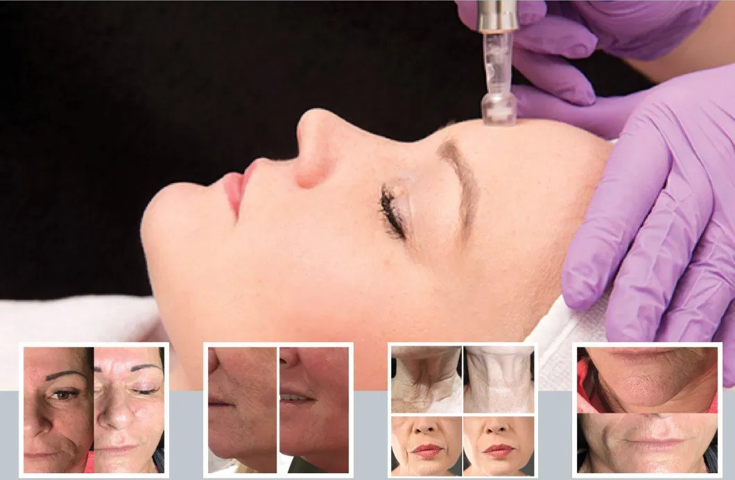 High Quality Hyaluronic Acid Chest Filling Deep Anti-Wrinkle Anti-Aging Injection Product Mesotherapy Serum
