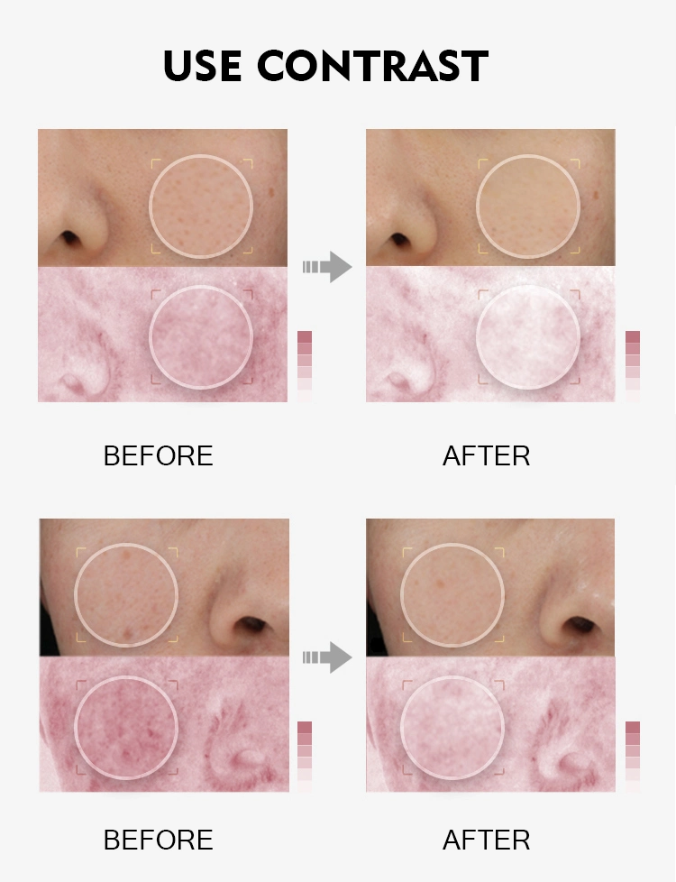 Face Toner Centella Spray Moisturizing Acne Treatment Acne Centella Face Toner Spray