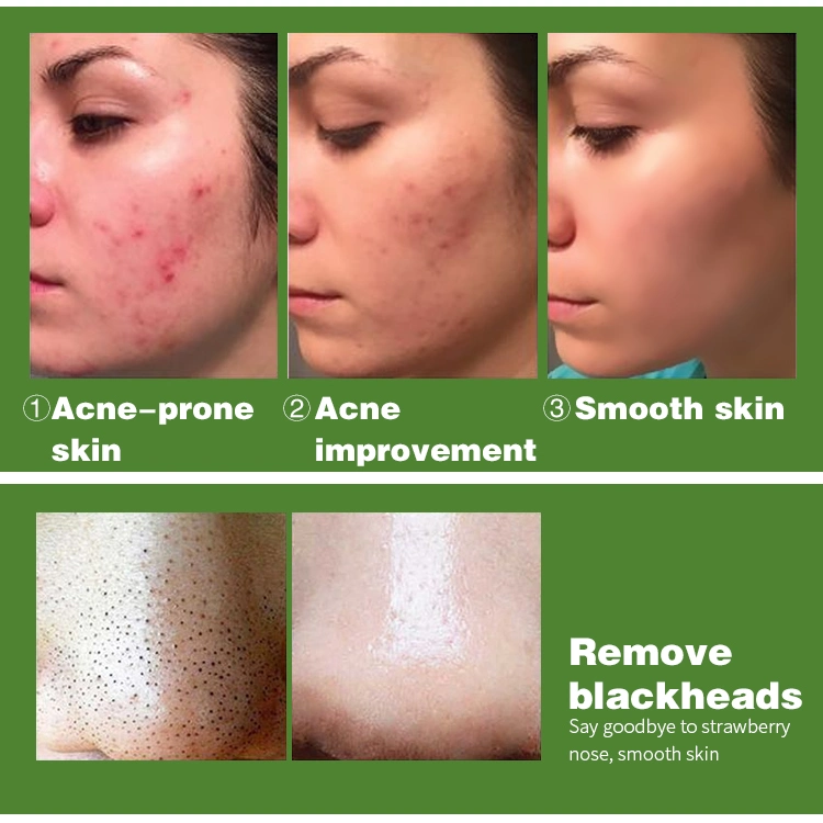 Ailke Wholesale Best Salycilic Acid Acne Pimple Face Brightening Acne Treatment Serum Facial