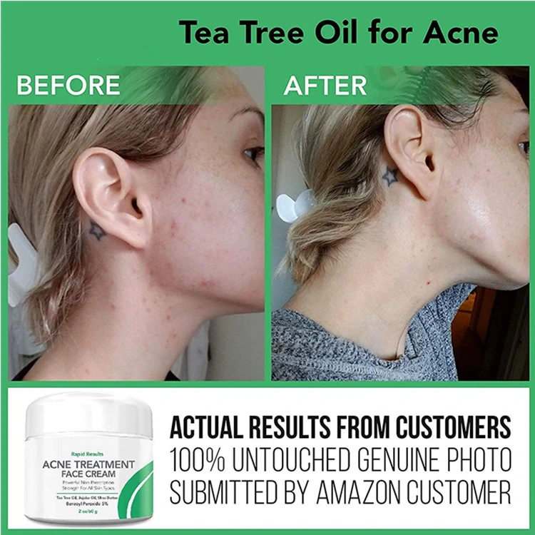 Natural Acne Treatment Face Cream Hormonal &amp; Cystic Acne Pimple Cream