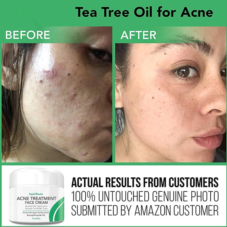 Natural Acne Treatment Face Cream Hormonal &amp; Cystic Acne Pimple Cream