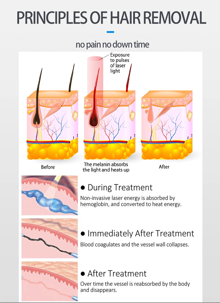 Alex Laser 755nm Alexandrite 1064nm ND YAG with Nitrogen Cooling Conducted Laser for Salon Use Permanent Hair Removal Laser Machine