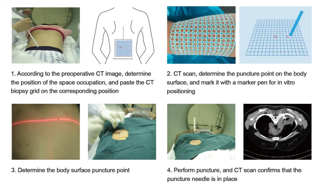 Medical Image Biopsy Positioning Tape Grid for Puncture Surgery