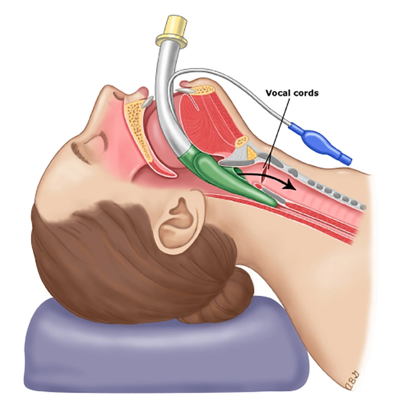 Silicone Reinforced Laryngeal Mask with Cuff Size 2.0