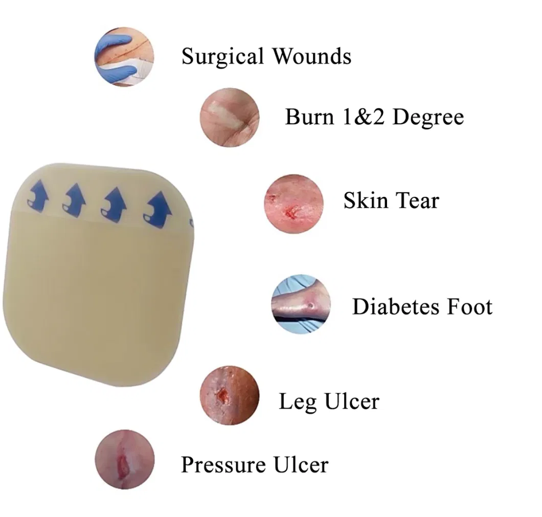 Medical Wound Care Adhesive Disposable Ultra Thin Hydrocolloid Dressing Used to Absorb Exudate