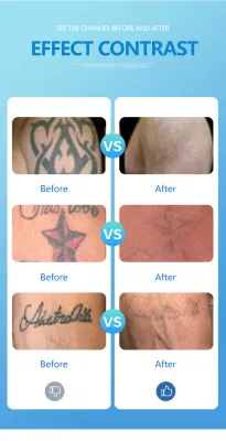Tres cabezales de tratamiento Q interruptor ND YAG Laser Tatuaje Eliminación Máquina para el blanqueamiento de la piel