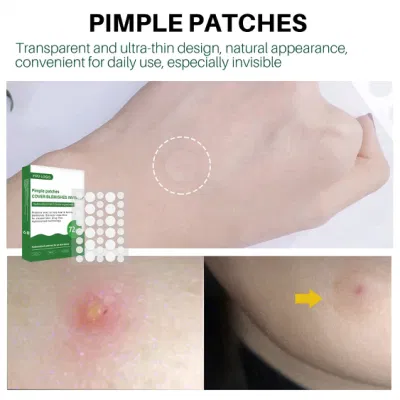 Cosmetics Facial Skin Care Acne Remover Hydrocolloid Patches Pimple Patch Acne Patch