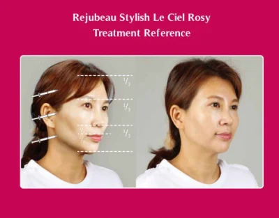 Le Ciel Rosy Plla Filler (CE) Royal Rejubeau Stylish Le Ciel Rosy Is a Medical Device for Treating Severe Facial Wrinkle