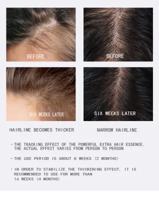 Prevenzione della perdita dei capelli Oily i capelli controllo del cuoio capelluto &amp; ricrescita Aumento della crescita dei capelli tonico