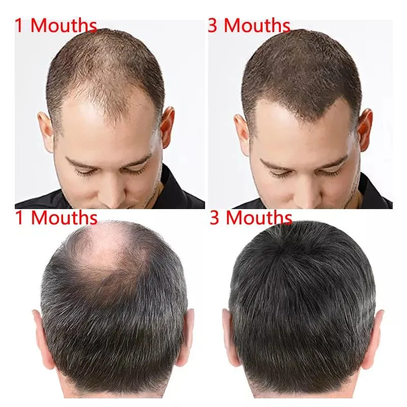 Minoxidil Promotes Hair Growth Build Your Own Label Nourishing Thick Care Hair Growth Private Label Kirkland Hair Oil